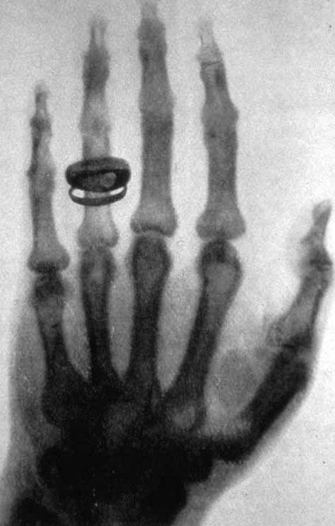 La première radiographie de l'histoire - main d'Anna Bertha Röntgen