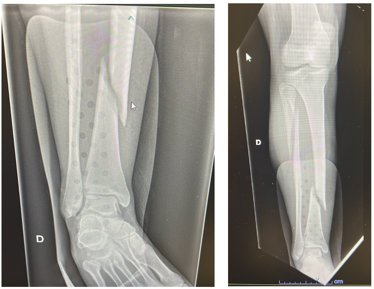 Comparaison radiographique montrant une double fracture initialement manquée