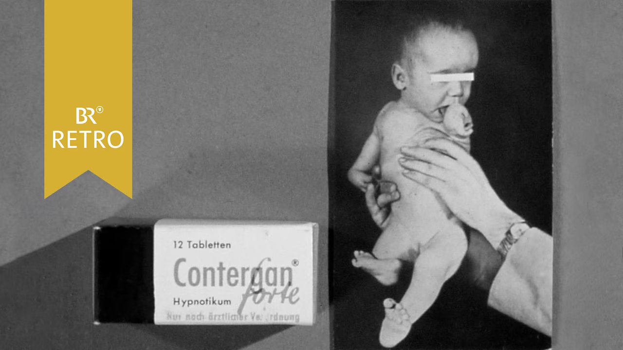 Enfant victime du thalidomide avec phocomélie